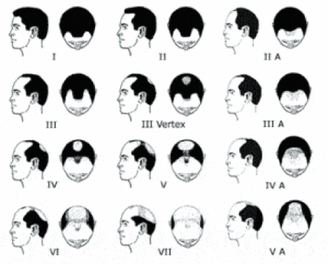 Hair Loss Diagram